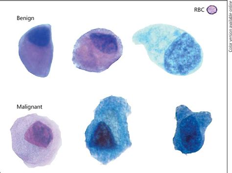 Figure 3 from High-Grade Urothelial Carcinoma on Urine Cytology Resembling Umbrella Cells ...