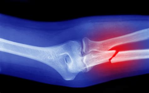 Fracture vs. Break: Is One Worse Than the Other?