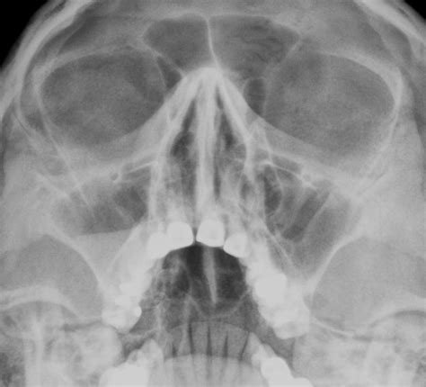 ACUTE MAXILLARY SINUSITIS | buyxraysonline