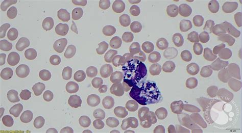 Gram positive cocci- Enterococcus faecalis