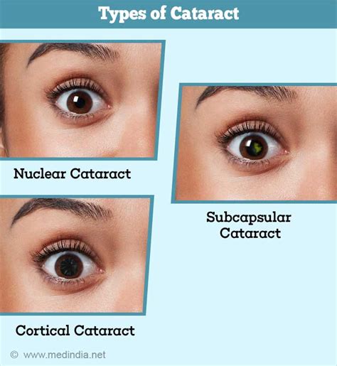 Cataract - Causes, Symptoms, Diagnosis, Treatment & Prevention