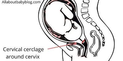 Abdominal Cerclage Vs Cervical Cerclage