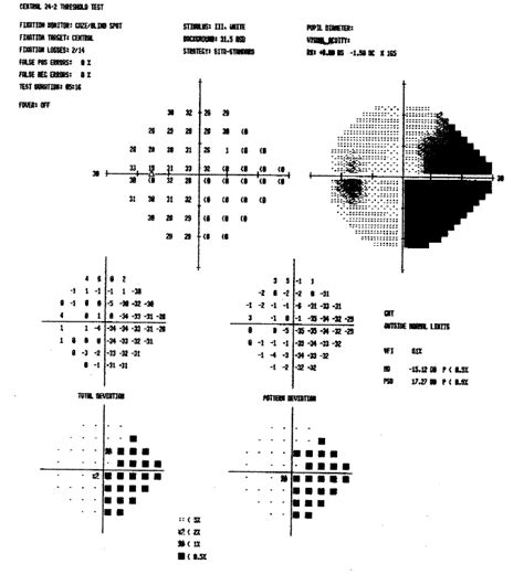 What Is A Visual Field Test? – NovaVision