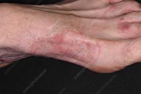 Ringworm on the foot - Stock Image - C051/1229 - Science Photo Library