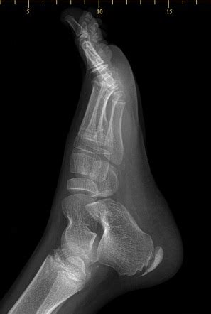 Normal Calcaneal X Ray