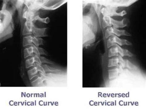 Loss Of Cervical Lordosis Due To Muscle Spasm