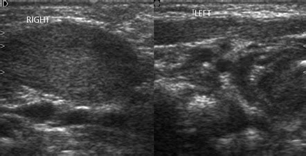 Fibromatosis colli | Radiology Case | Radiopaedia.org