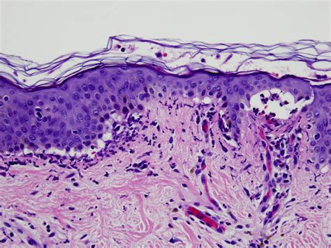 Epidermolysis Bullosa Uk