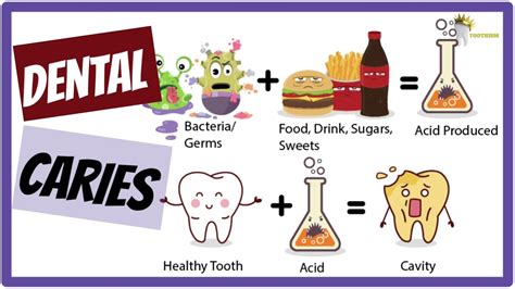 DENTAL CARIES- Etiology, Keyes Jordan diagram, Stephan's Curve SIMPLIFIED! - Dental Clinic