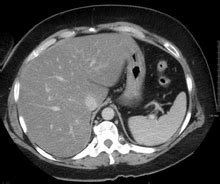 Steatosis - Wikipedia