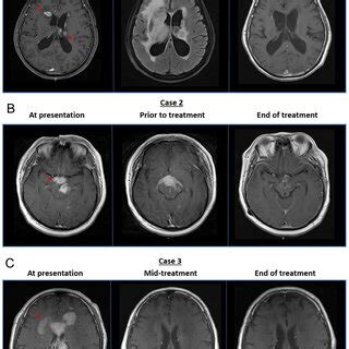 (PDF) Absence of meaningful neurocognitive recovery in comatose patients with primary central ...