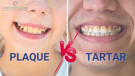 Plaque vs. Tartar and How To Remove Them At Home