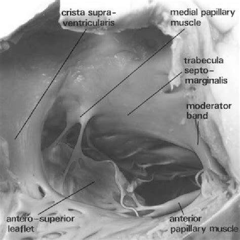 Figure 41.6 from Surgery For Congenital Heart Defects | Semantic Scholar