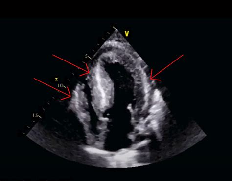 Cureus | Suspecting Cardiac Amyloidosis in Congestive Heart Failure