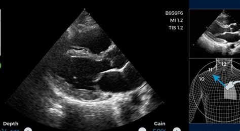 First AI-Guided Ultrasound for Cardiac Imaging Approved by Regulators - Xtalks