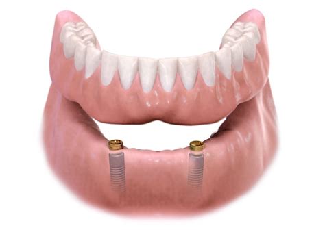 Implant Overdenture — Tri-State Oral and Maxillofacial Surgery