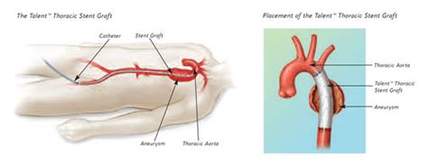 Endovascular Stent Repair of Thoracic Aortic Aneurysms