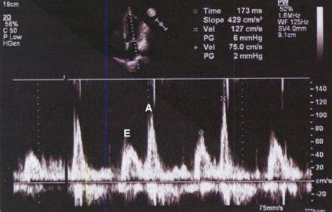 Grade i diastolic dysfunction - Answers on HealthTap