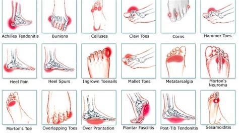 Outside Foot Pain Chart