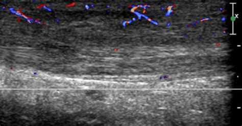 ultrasound treatment for achilles tendonitis - geney-mezquita