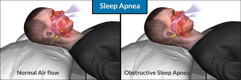 Obstructive Sleep Apnoea Treatment In Pune & PCMC | Mild Sleep Apnea Treatment In Pune & PCMC