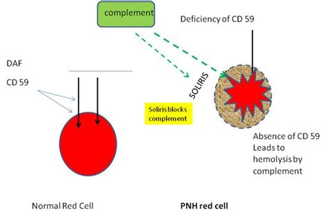 Paroxysmal nocturnal hemoglobinuria (PNH) | Medical Junction