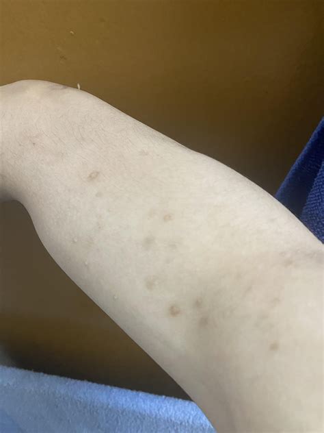 Arm Acne Scars Solution : r/SkincareAddicts