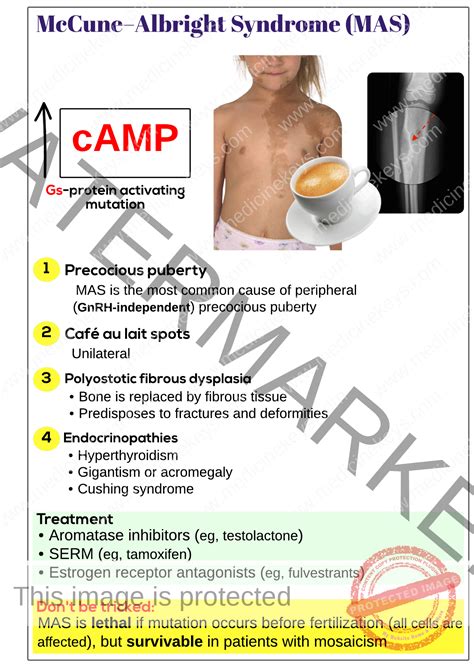 McCune–Albright syndrome (MAS) - Medicine Keys for MRCPs