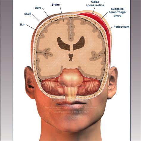 Subgaleal Hemorrhage - TrialExhibits Inc.