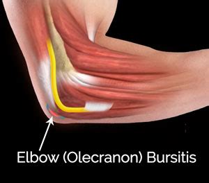 Elbow Bursitis Treatment New York City | Olecranon Bursitis Manhattan, NYC