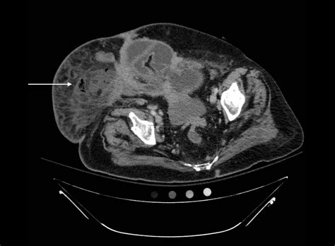 Necrotizing Soft Tissue Infection - JETem