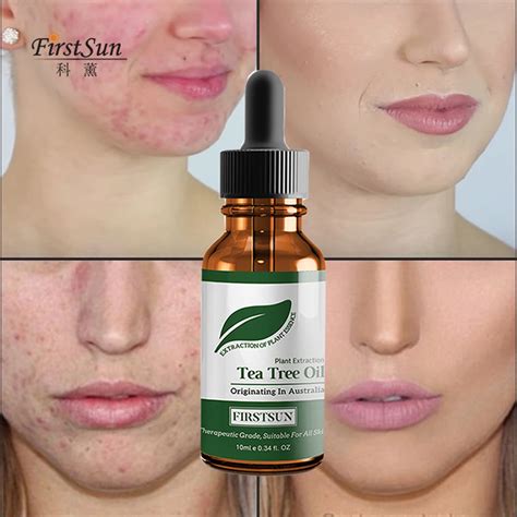 Tea Tree Essential Oil Blackhead Remover Acne Treatment Oil Acne ...