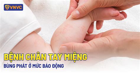 BỆNH TAY CHÂN MIỆNG: NGUYÊN NHÂN, TRIỆU CHỨNG, BIẾN CHỨNG VÀ CÁCH PHÒNG ...