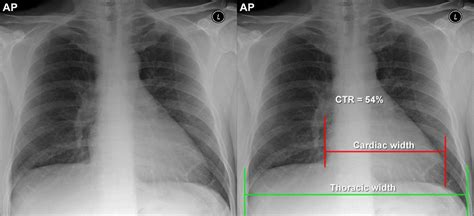 Types Of Chest X-Rays Part AP Vs PA [UndergroundMed], 47% OFF