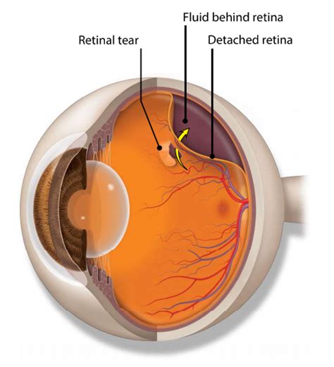 Lattice Degeneration – Macula Retina Vitreous Center