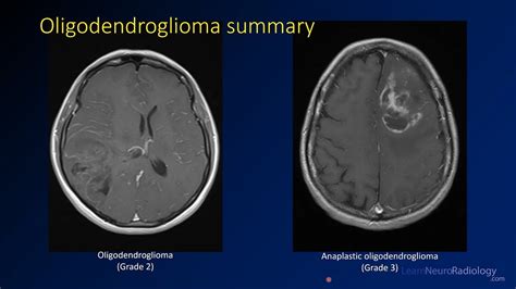 Imaging brain tumors - 3 - Oligodendrogliomas - YouTube