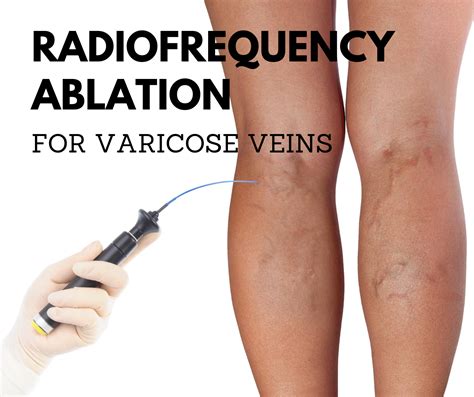 Lower Limb Venous Ablation