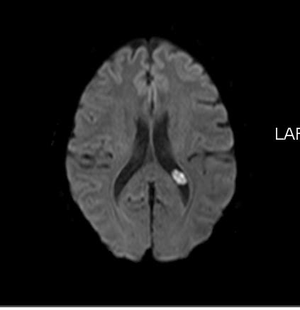 Choroid Plexus Xantogranulomata-MRI - Sumer's Radiology Blog