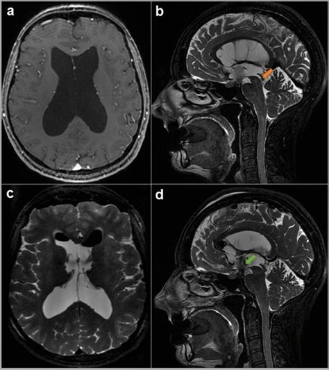 Pre- and post-operative MRI of an obstructive hydrocephalus treated by ...