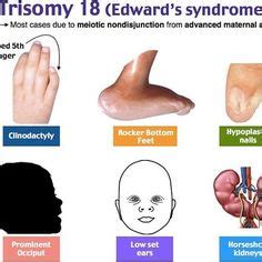 Edwards Syndrome (Trisomy 18) Trisomies occur when there is a triplet ...