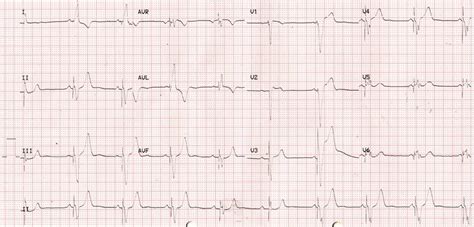 Temporary pacing ECG – All About Cardiovascular System and Disorders