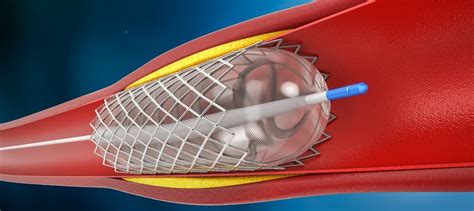 Is an Angioplasty Procedure Best for You? | Dr. Stephen Sinatra