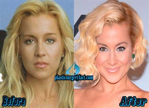 Kellie Pickler Plastic Surgery Before and After Pictures - Plastic ...