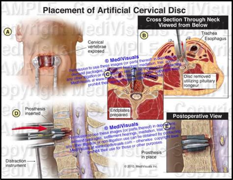 Anterior Cervical Arthroplasty (Disc Replacement) - Medivisuals Inc.