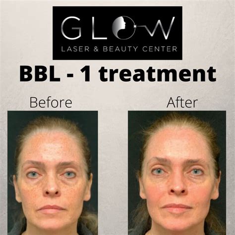 Forever Young BBL Treatment in Erie, PA - Glow Laser Beauty