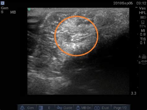 Ultrasound image of the lipoma (outlined by Ultrasound image of the... | Download Scientific Diagram