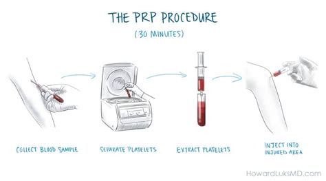 PRP Injection Recovery Time – Howard J. Luks, MD