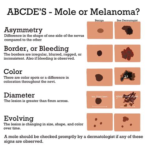 Cancerous Moles Vs Normal Moles