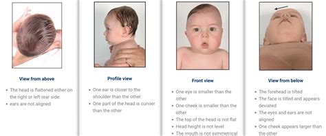 Difference between plagiocephaly and brachycephaly