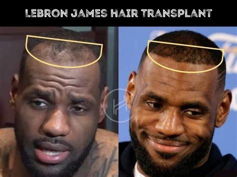 LeBron James Hair Transplant - Hair Loss & Technical Analysis